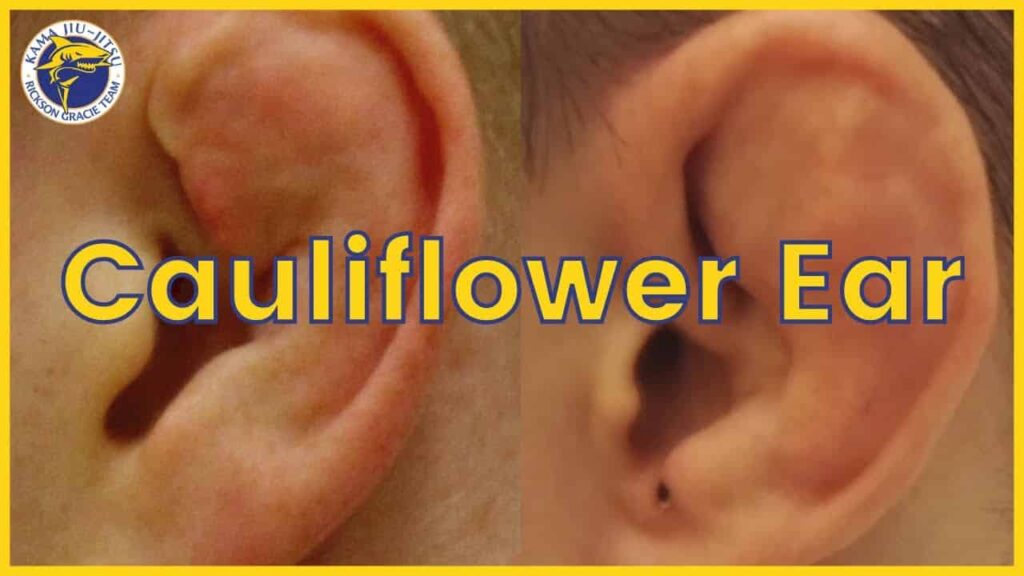 How To Prevent Cauliflower Ear 😮