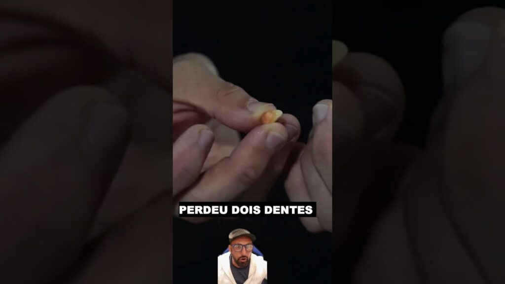 Pedeu os dentes da frente #jiujitsu #bjj #mma #judoindia